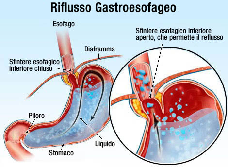 reflusso-gastroesofageo